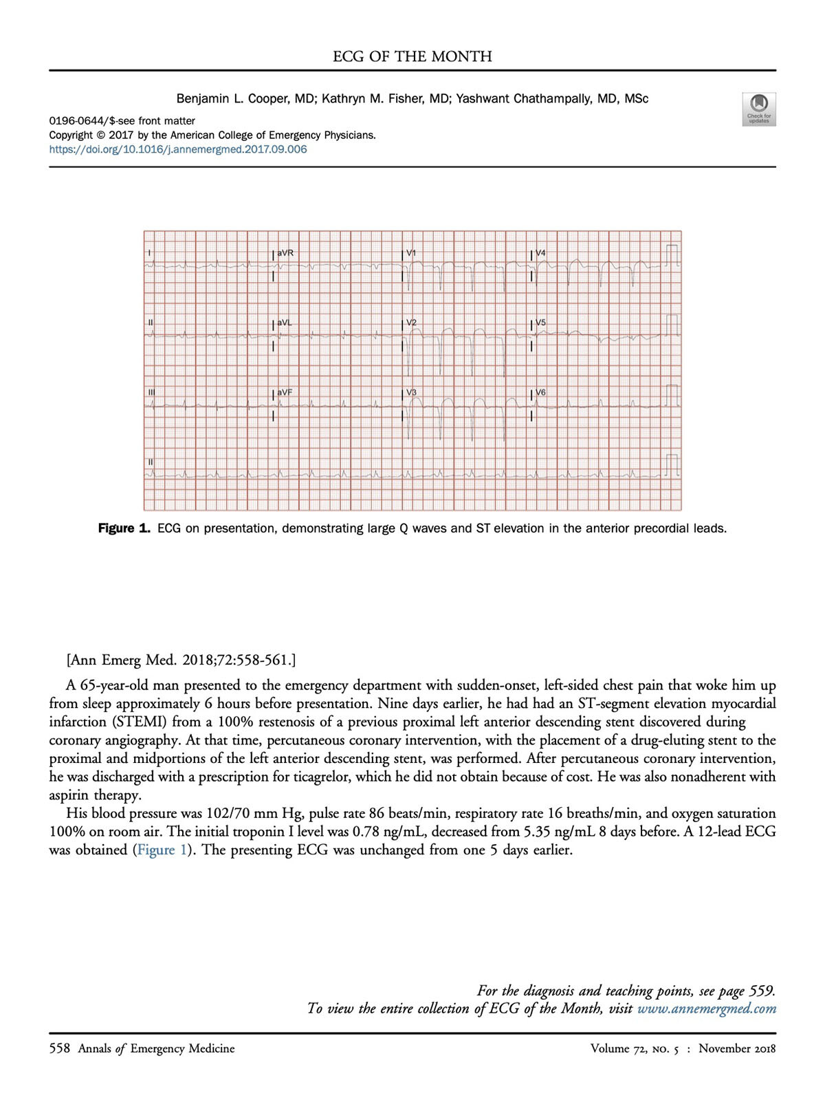 Cooper BL, Fisher KM, Chathampally Y. Man with left-sided chest pain. Ann Emerg Med. 2018;72(5):558-561. Man with left-sided chest pain
