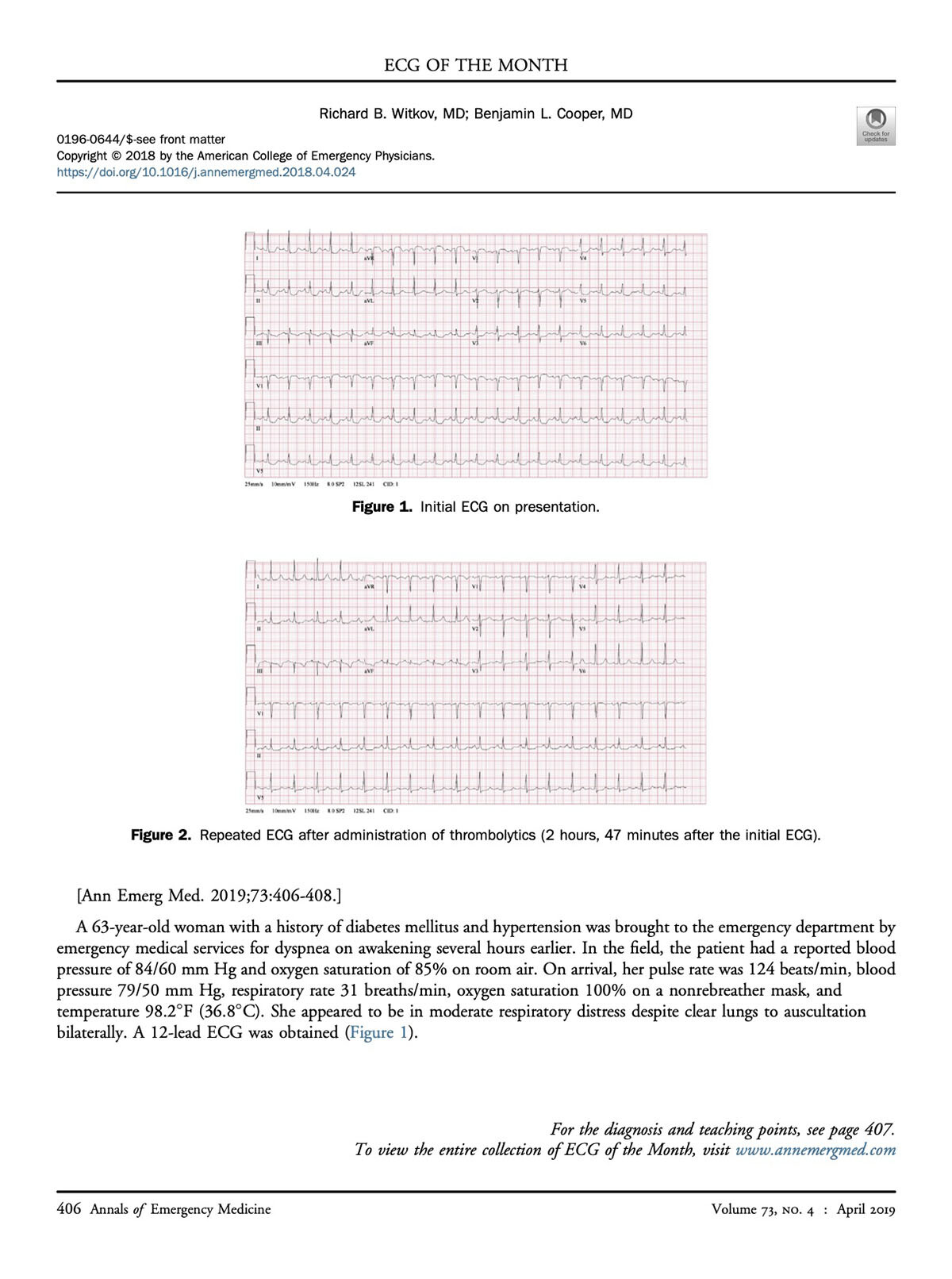 Witkov RB, Cooper BL. An ominous ecg pattern. Ann Emerg Med. 2019;73(4):406-408. An ominous ECG pattern