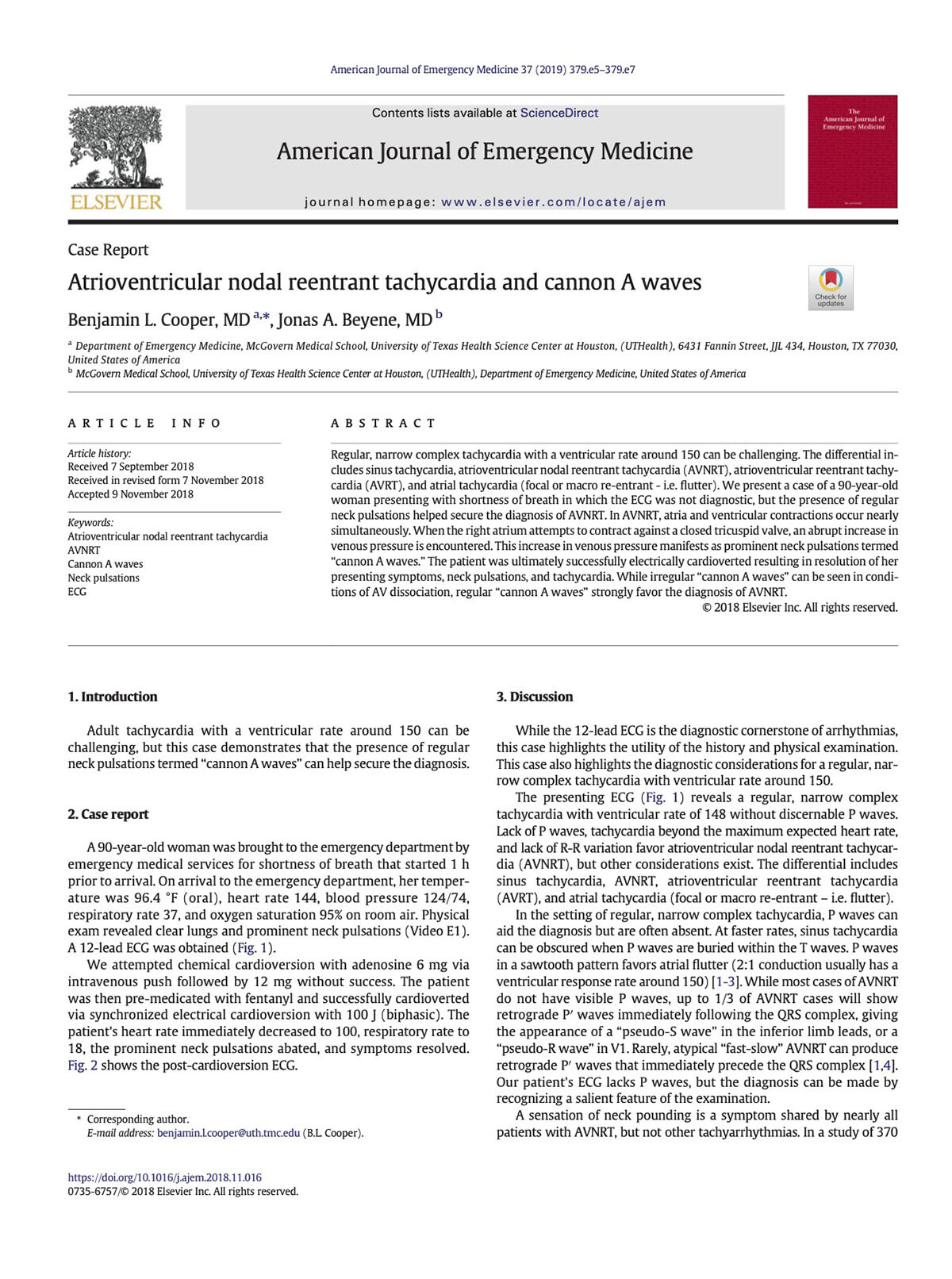 Cooper BL, Beyene JA. Atrioventricular nodal reentrant tachycardia and cannon A waves. Am J Emerg Med. 2019;37(2):379.e5-379.e7. Atrioventricular nodal reentrant tachycardia and cannon A waves