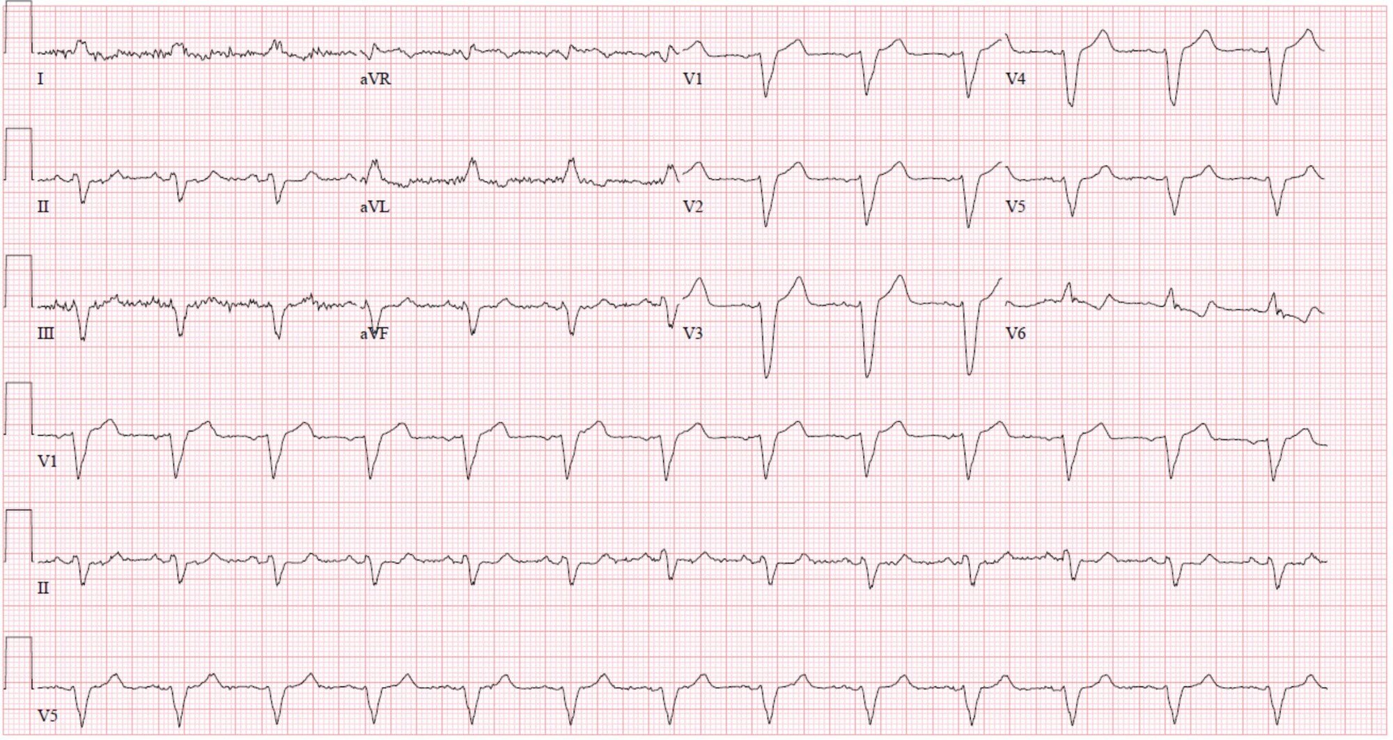 ECG