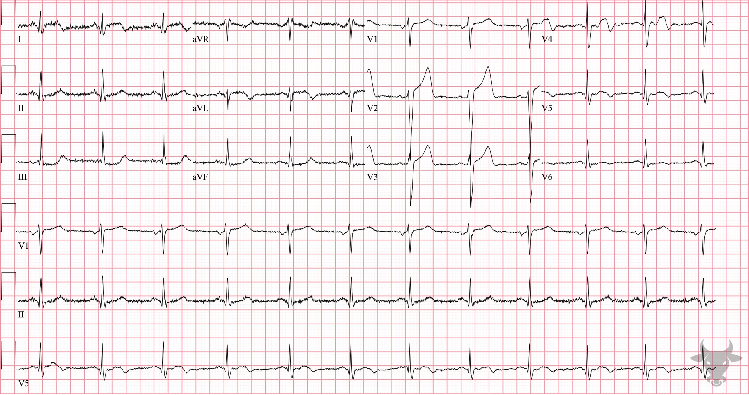 ECG Showing ST-elevation Myocardial Infarction