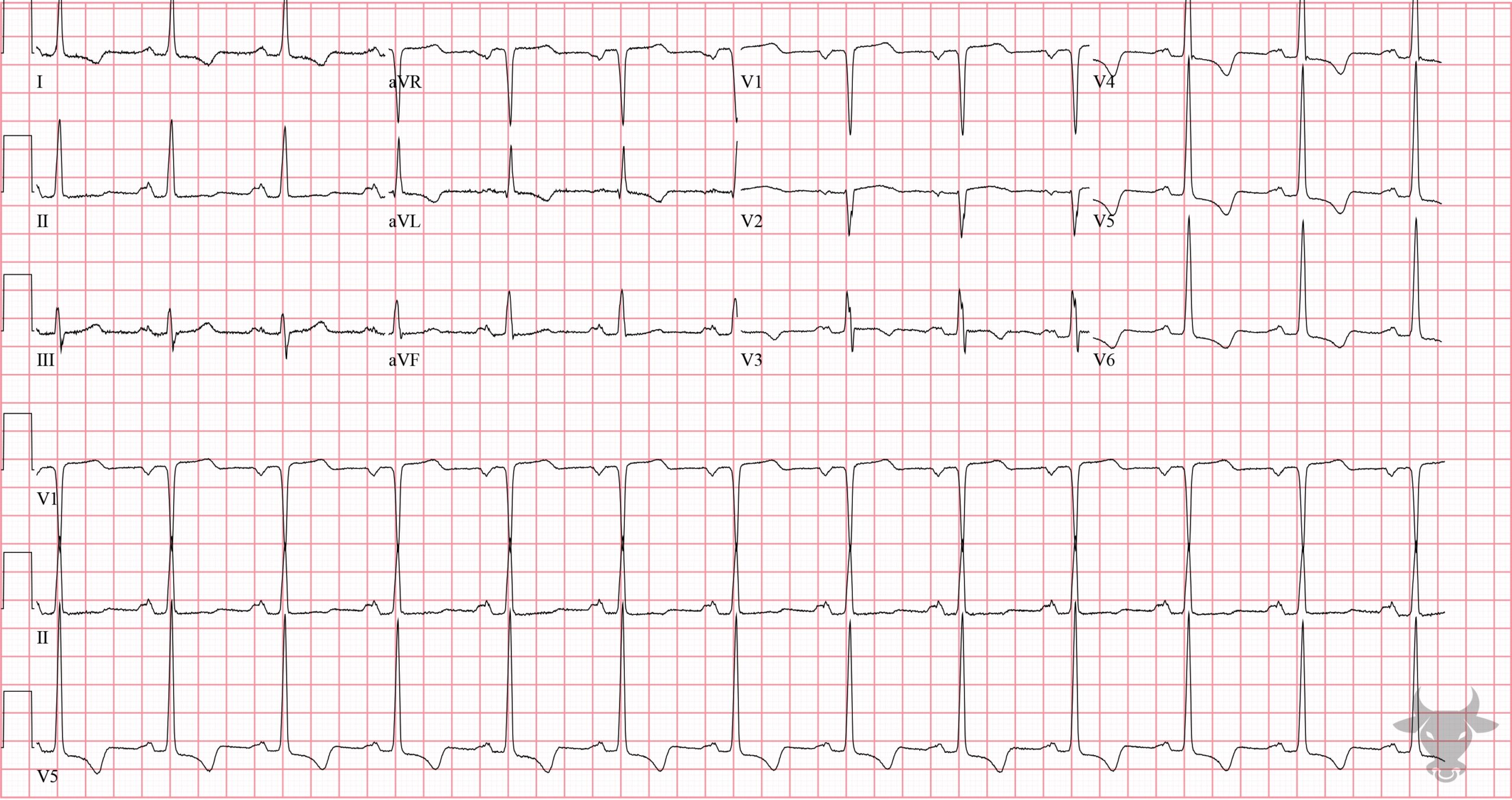 ECG Showing Hypertrophic Cardiomyopathy