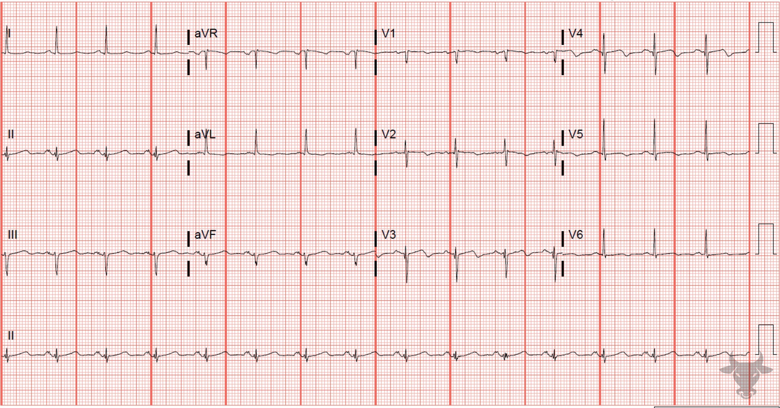 ECG Showing T-wave Inversions
