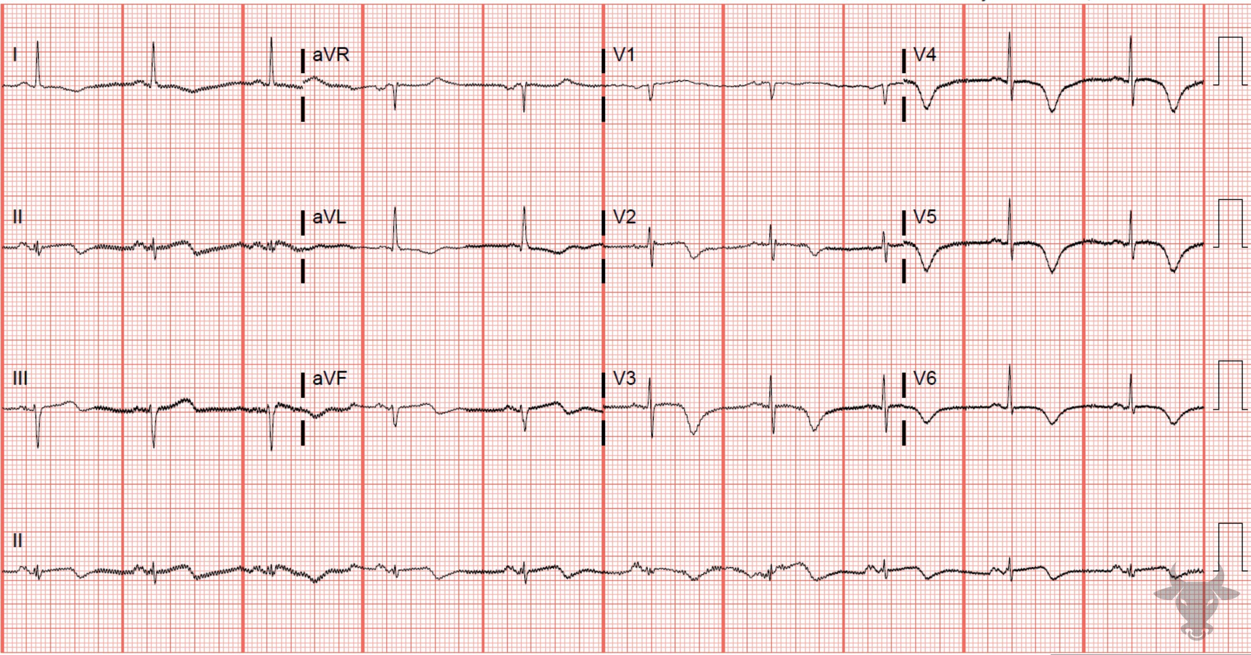 ECG Showing T-wave Inversions