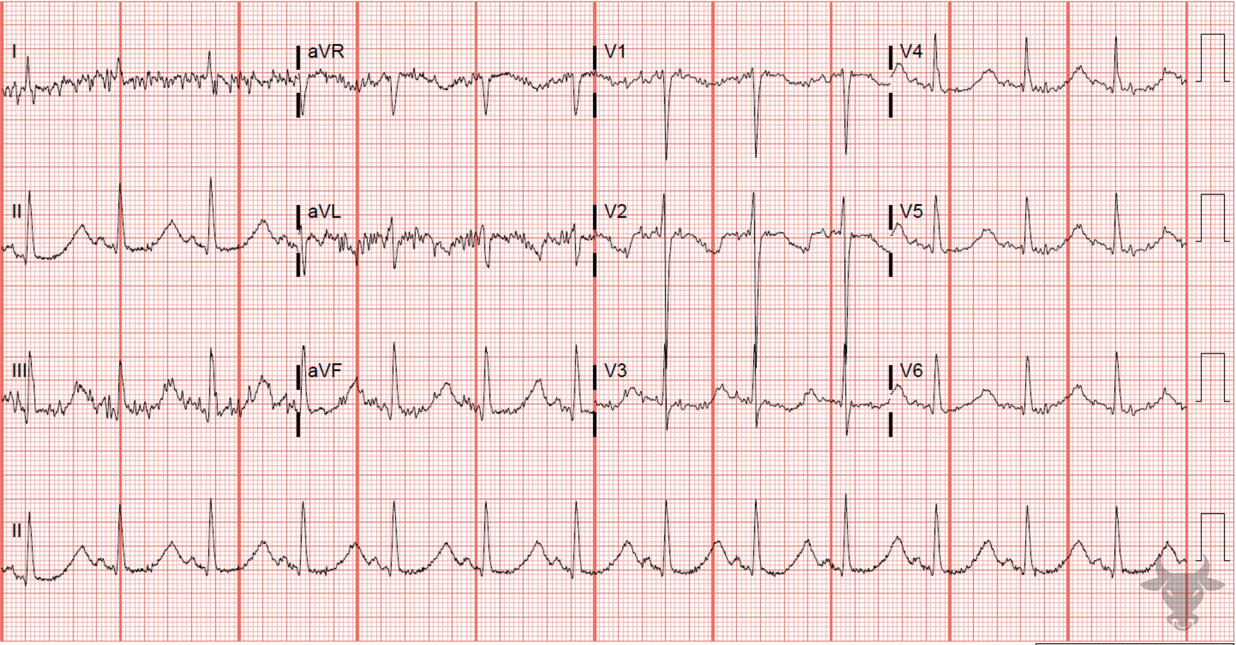 ECG Showing Torsade de Pointes