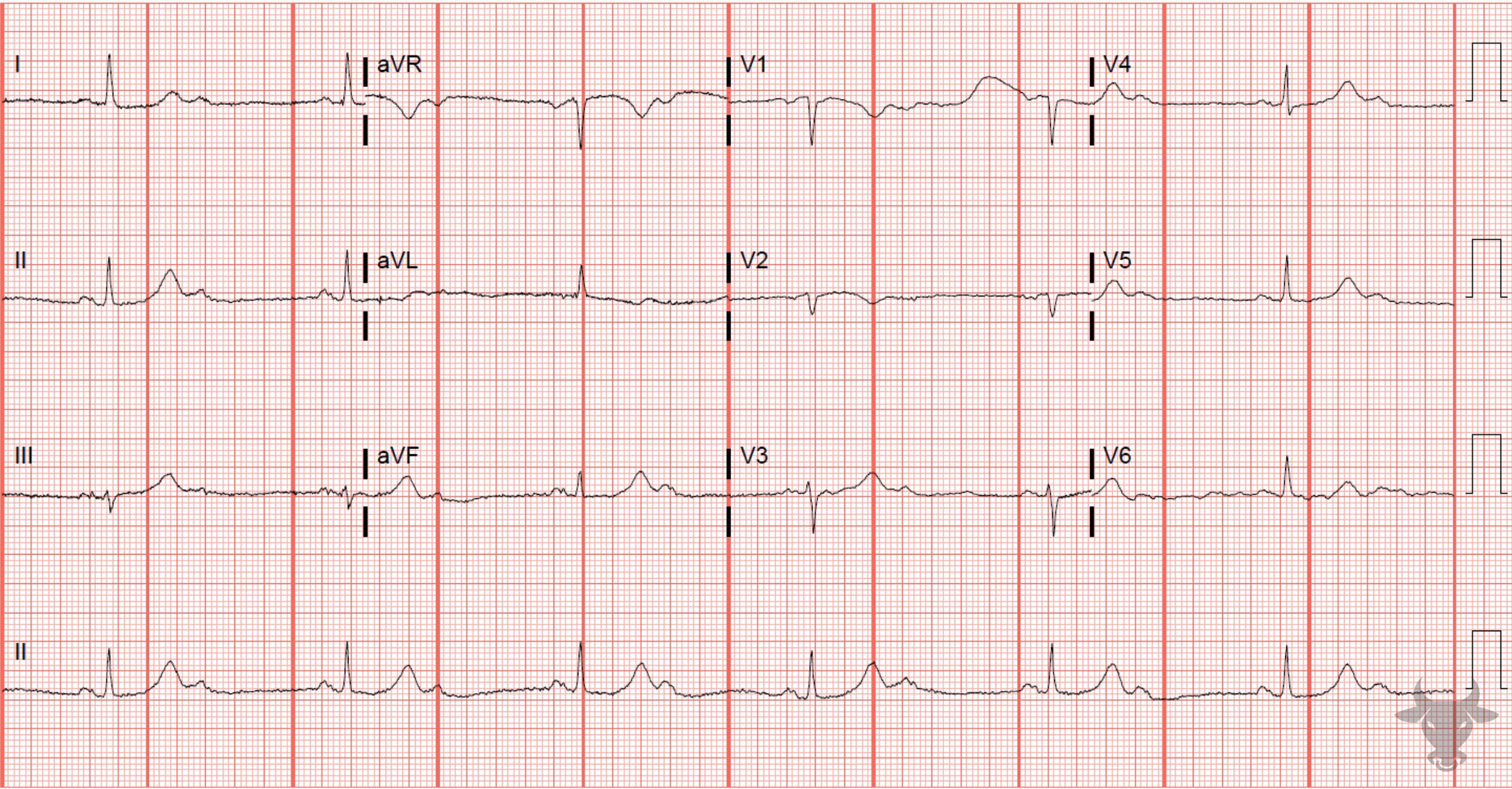 ECG Showing Second Degree Atrioventricular Block 2:1