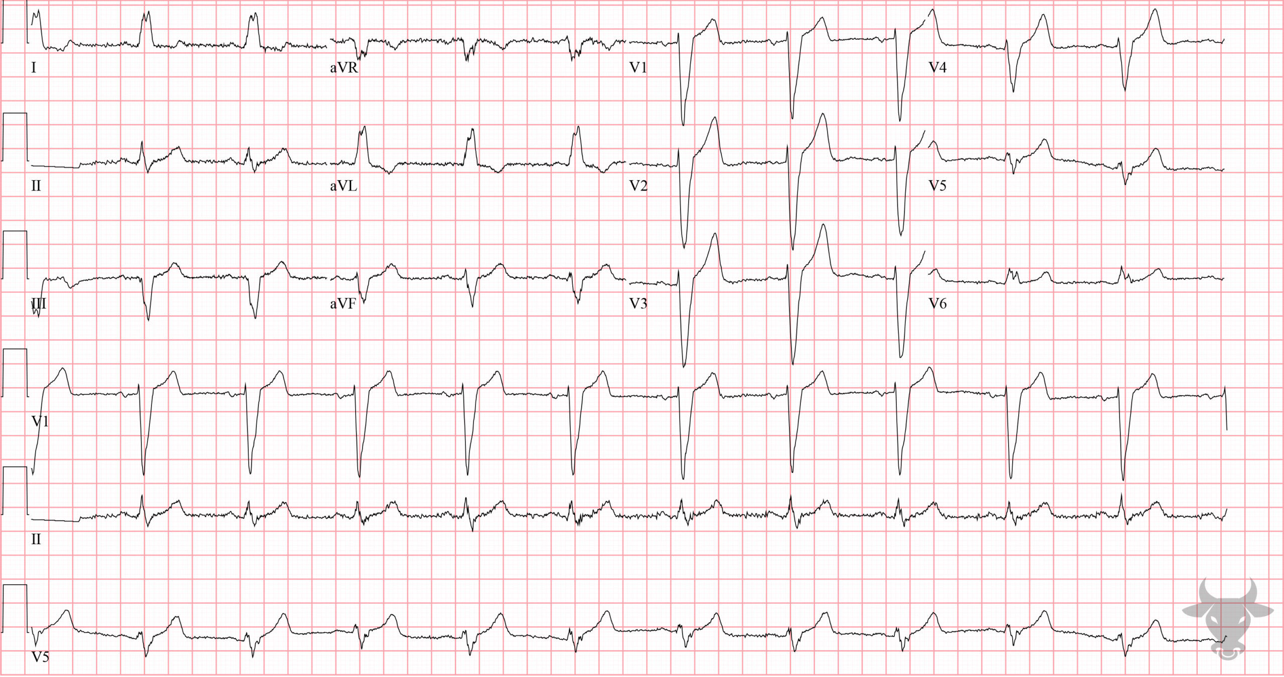 ECG Showing Left Bundle Branch Block