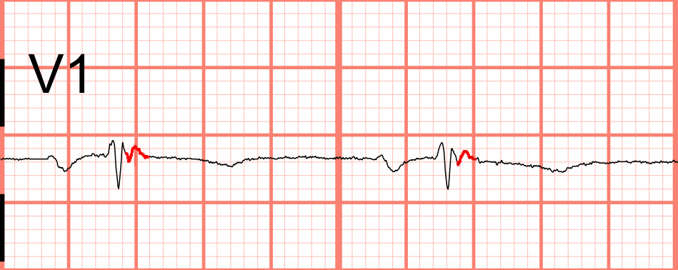 Epsilon Wave