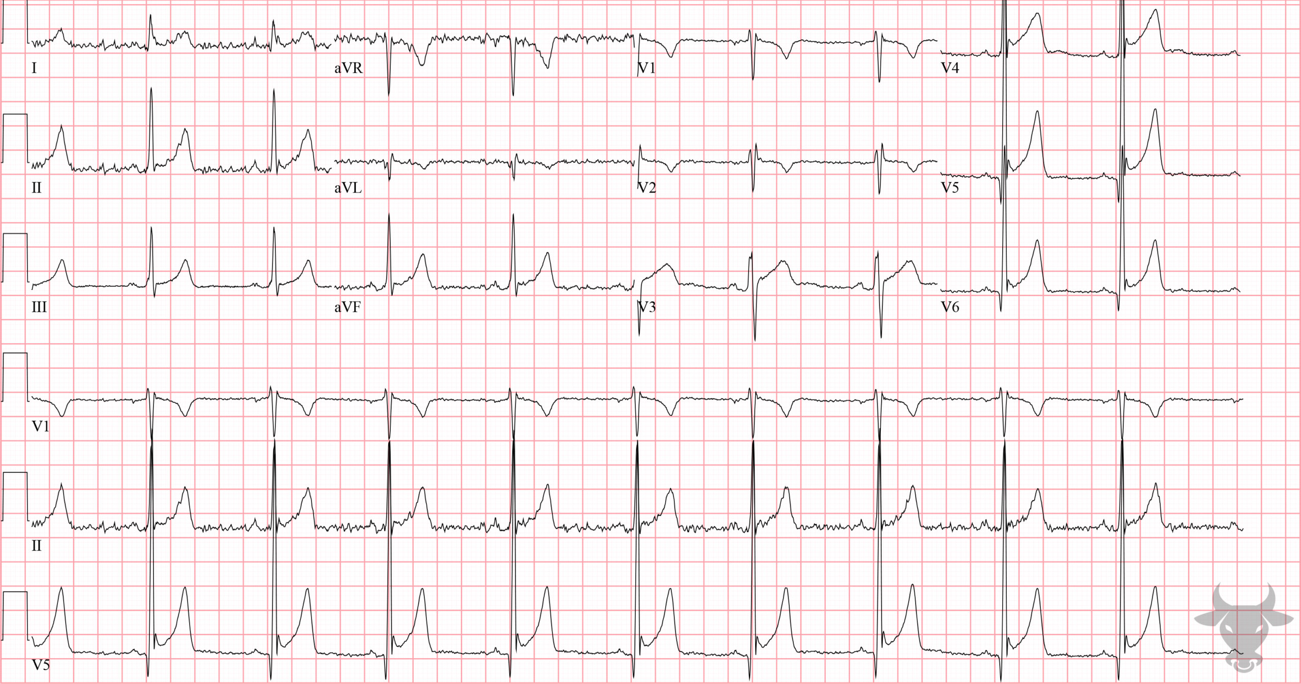 ECG Showing Early Repolarization