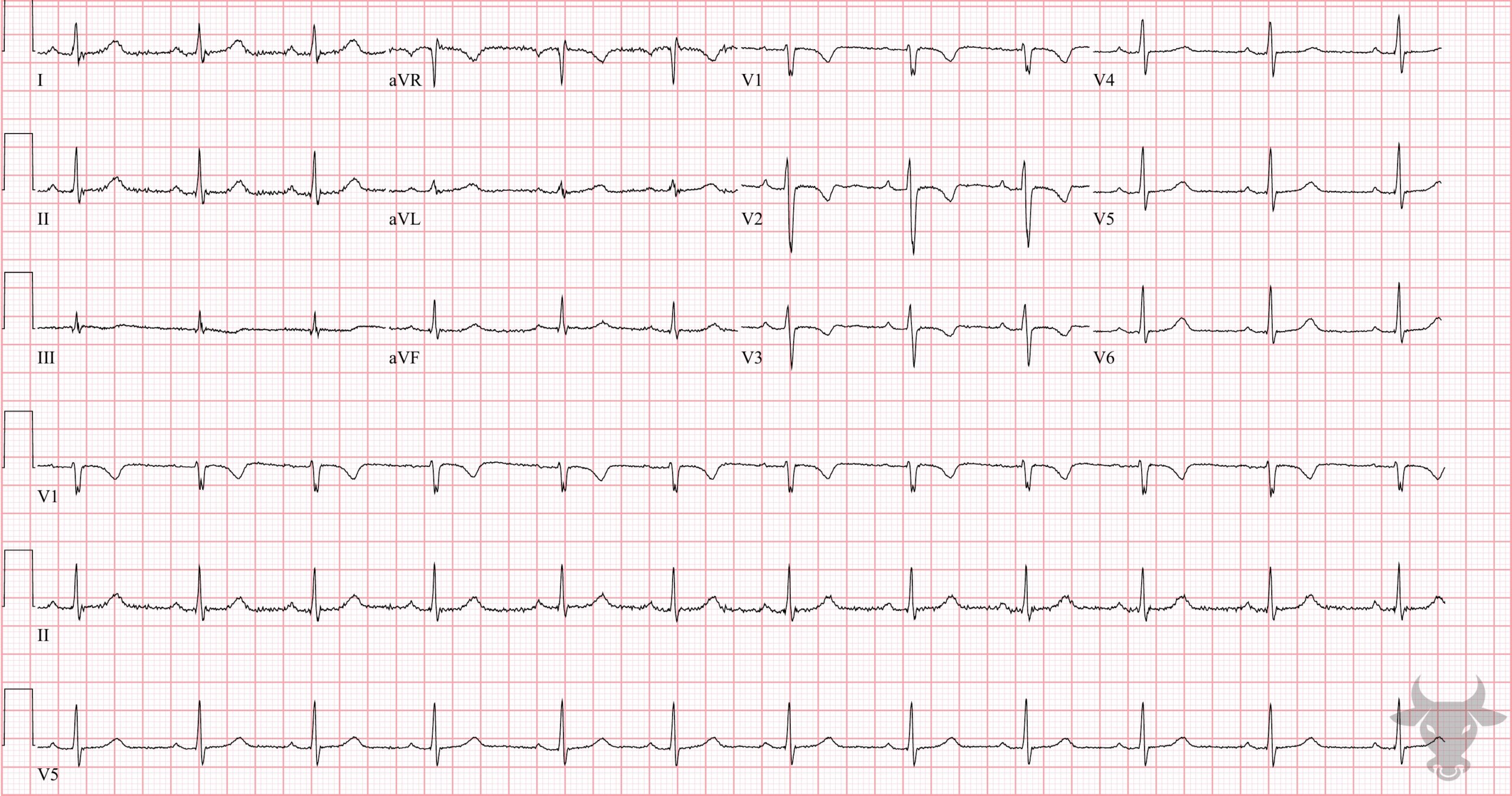 Persistent Juvenile T Wave Pattern